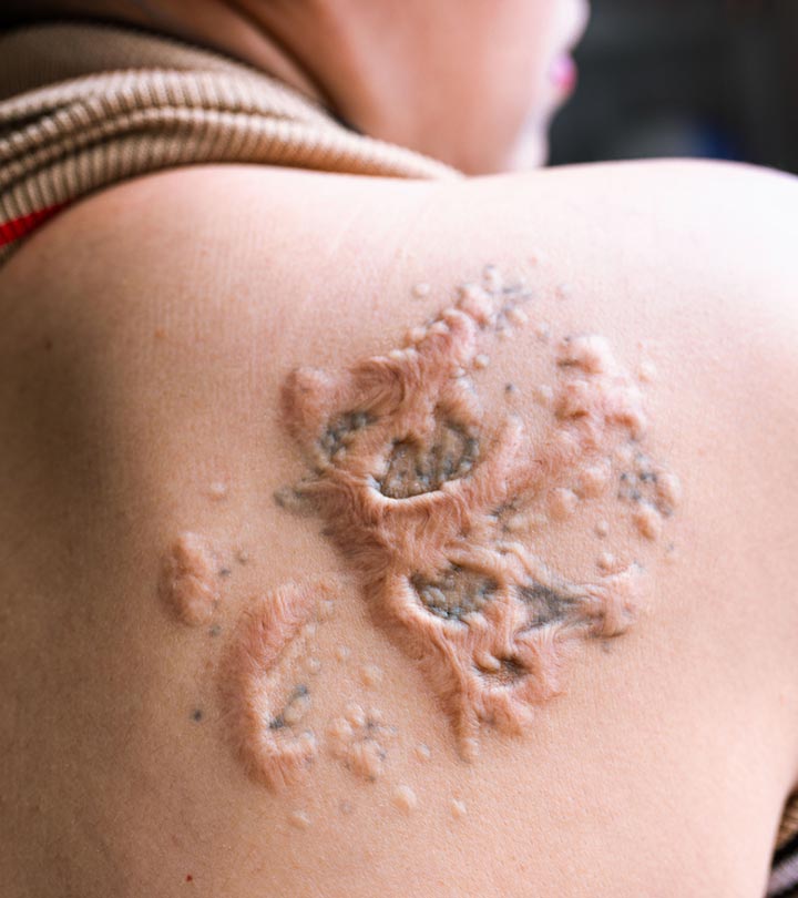 Does your tattoo inkink from tattoo in lymph nodes? Does your tattoo inkink from tattoo in lymph nodes?
