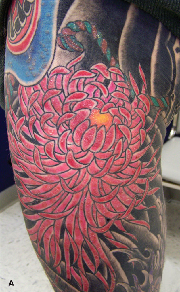 How does reaction to red tattoo ink impact the skin? How does reaction to red tattoo ink impact the skin?